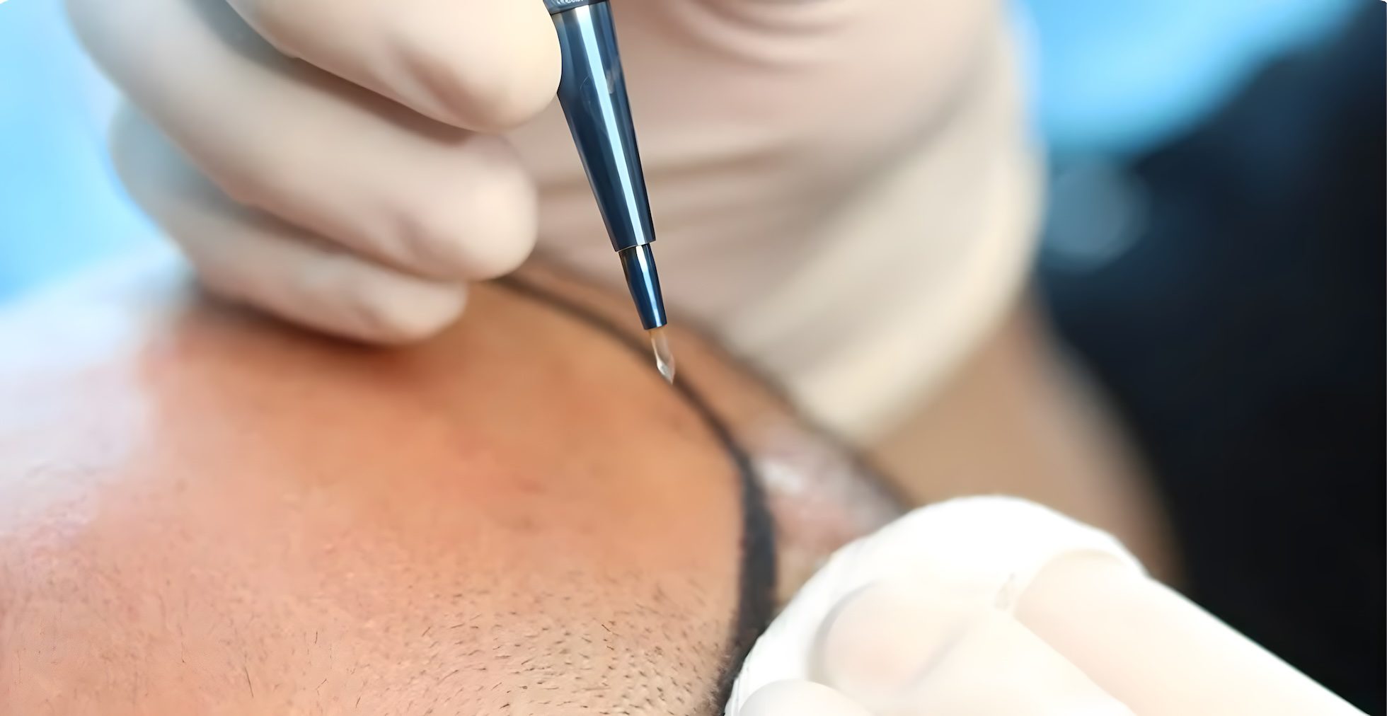 hair-transplant